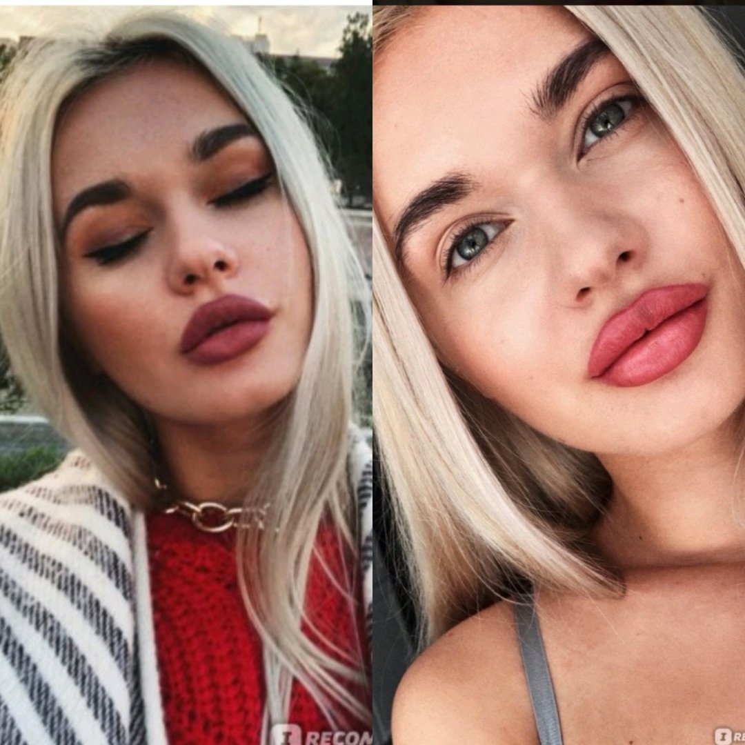 Накаченные губы до и после фото красивые фото