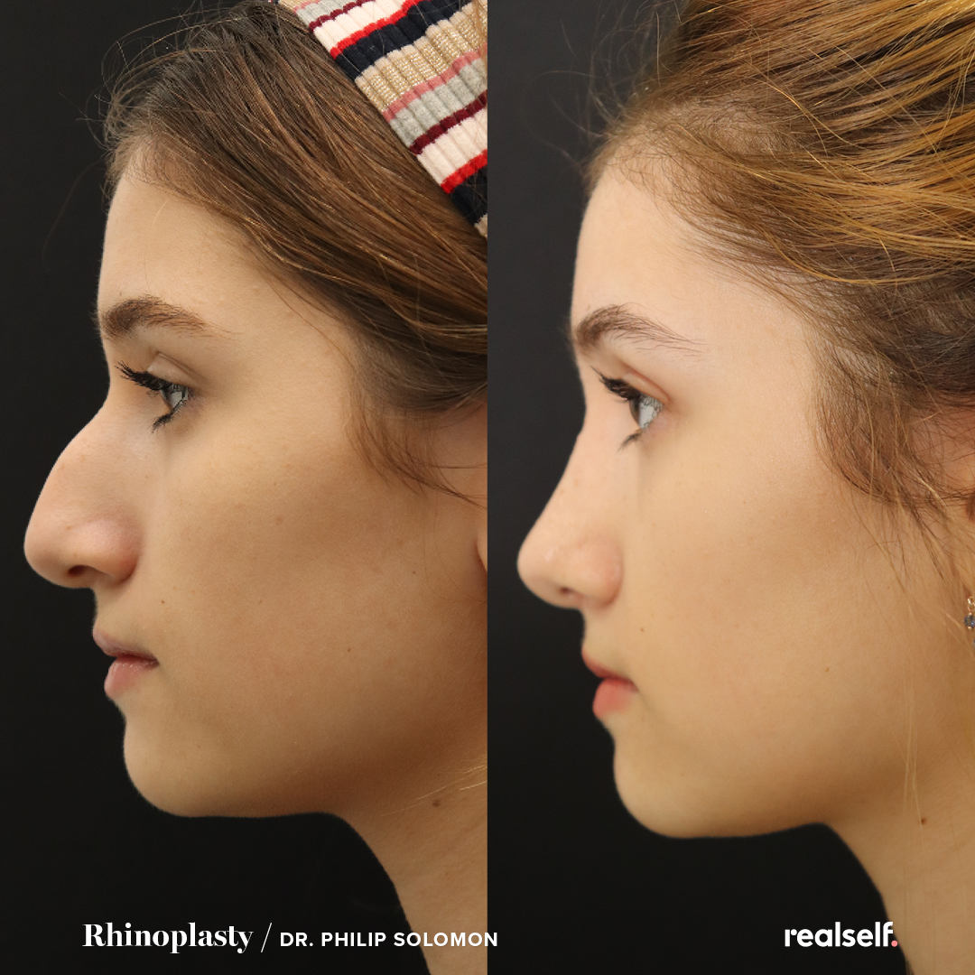 Под каким носом. Ринопластика. Красивая форма носа. Прямой нос у женщин. Ринопластика красивый нос.
