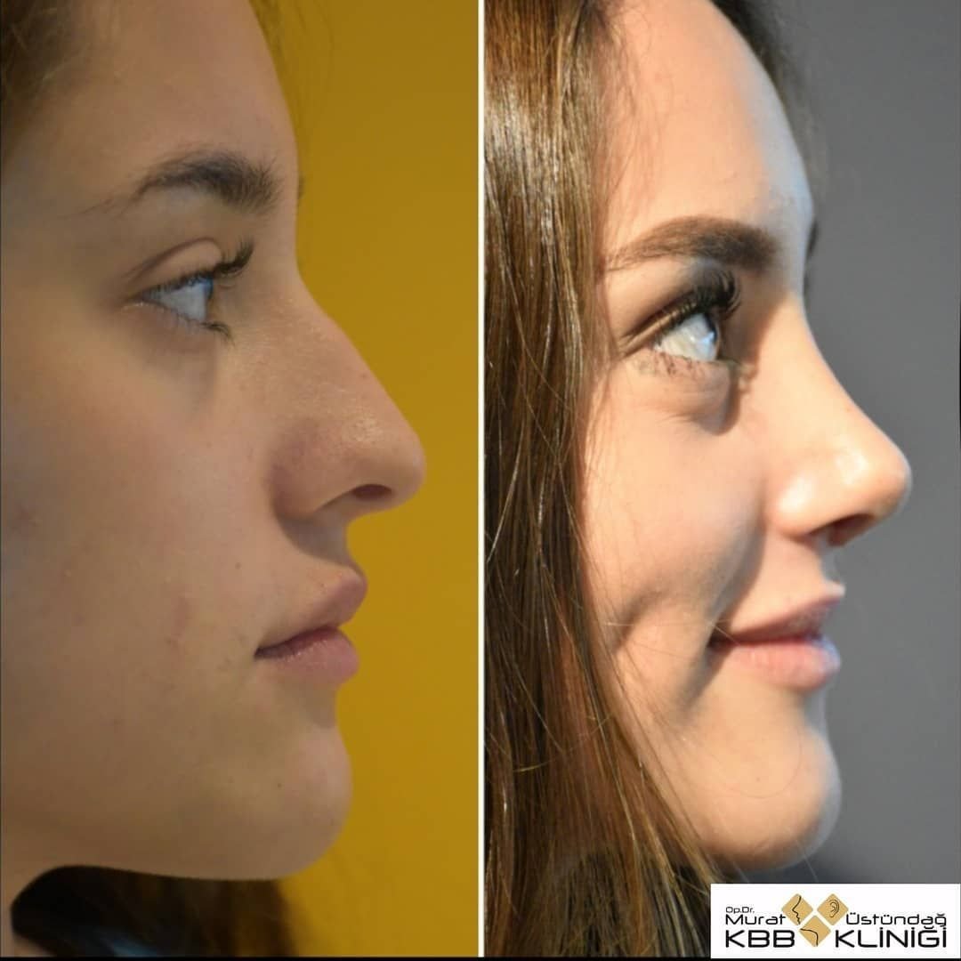 Какие операции делают на носу. Инъекционная ринопластика. Ринопластика до и после. Пластика носа до и после. Ринопластика красивый нос.