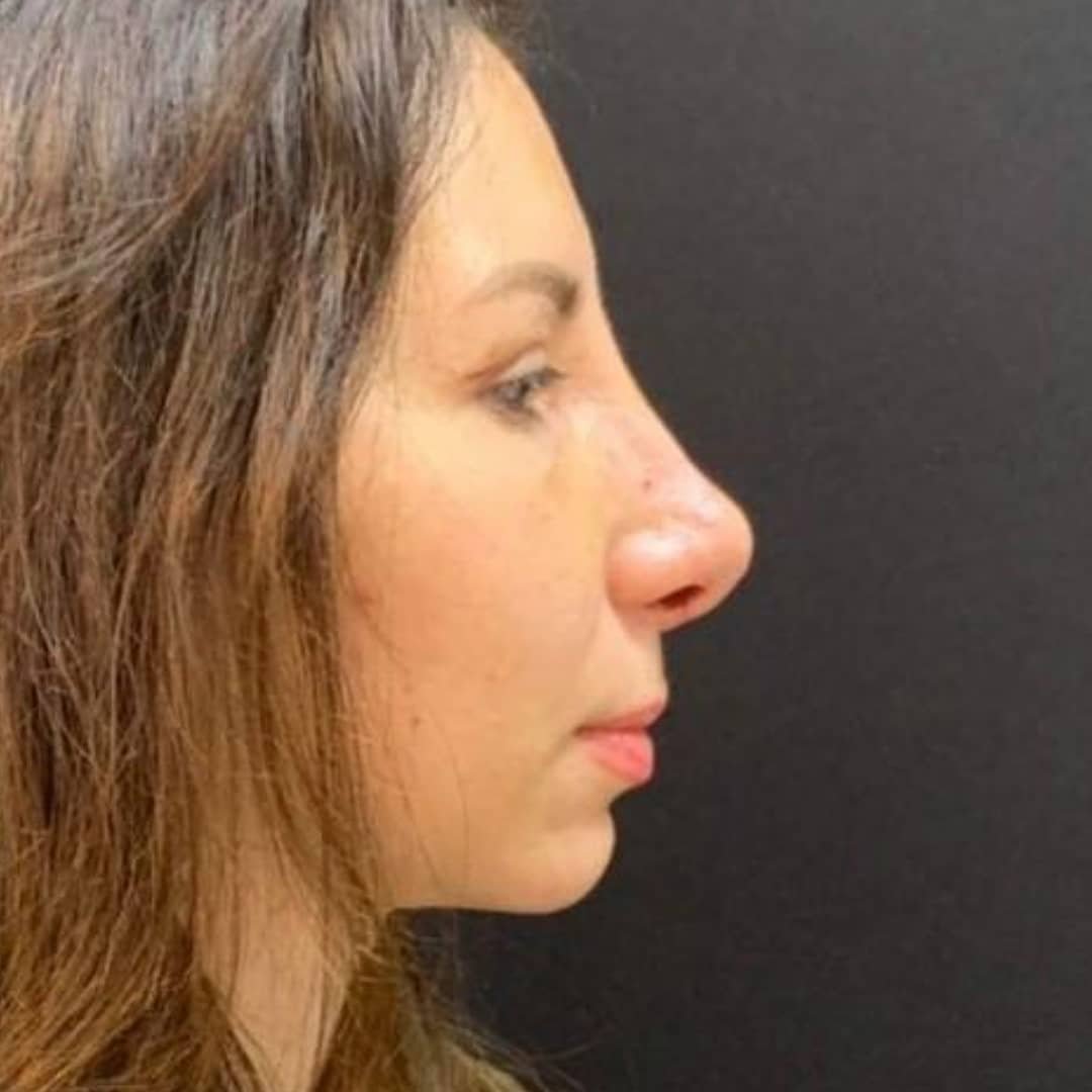 Курносый нос после ринопластики