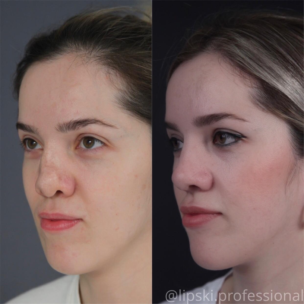 Ринопластика курносого носа до и после фото