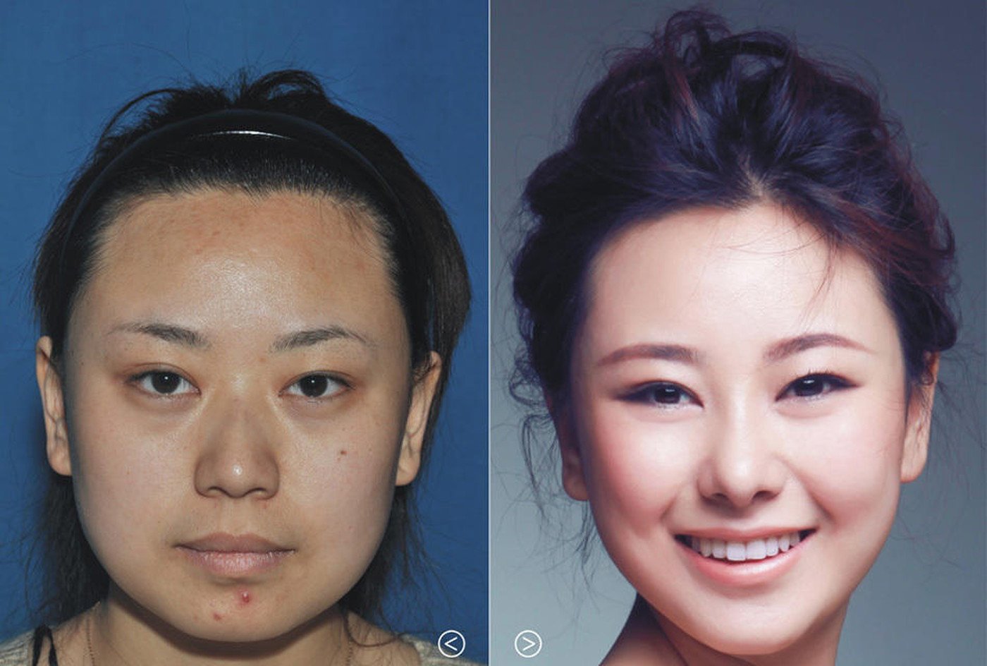 Пластическая хирургия до и после