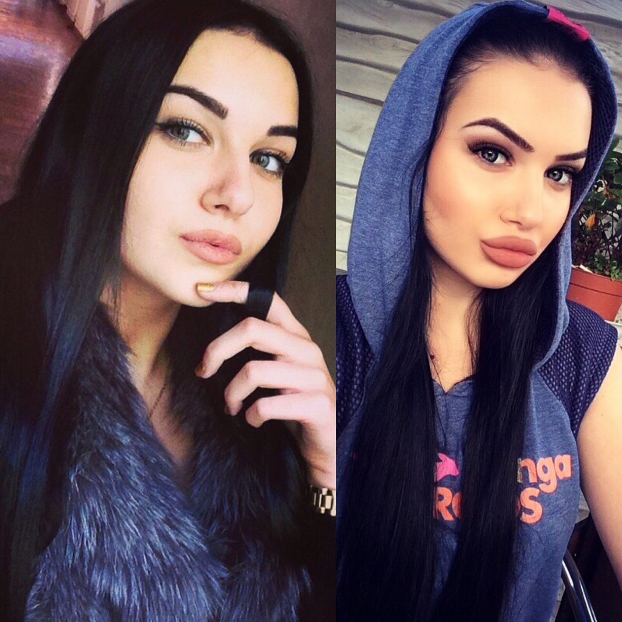 Накаченные губы до и после