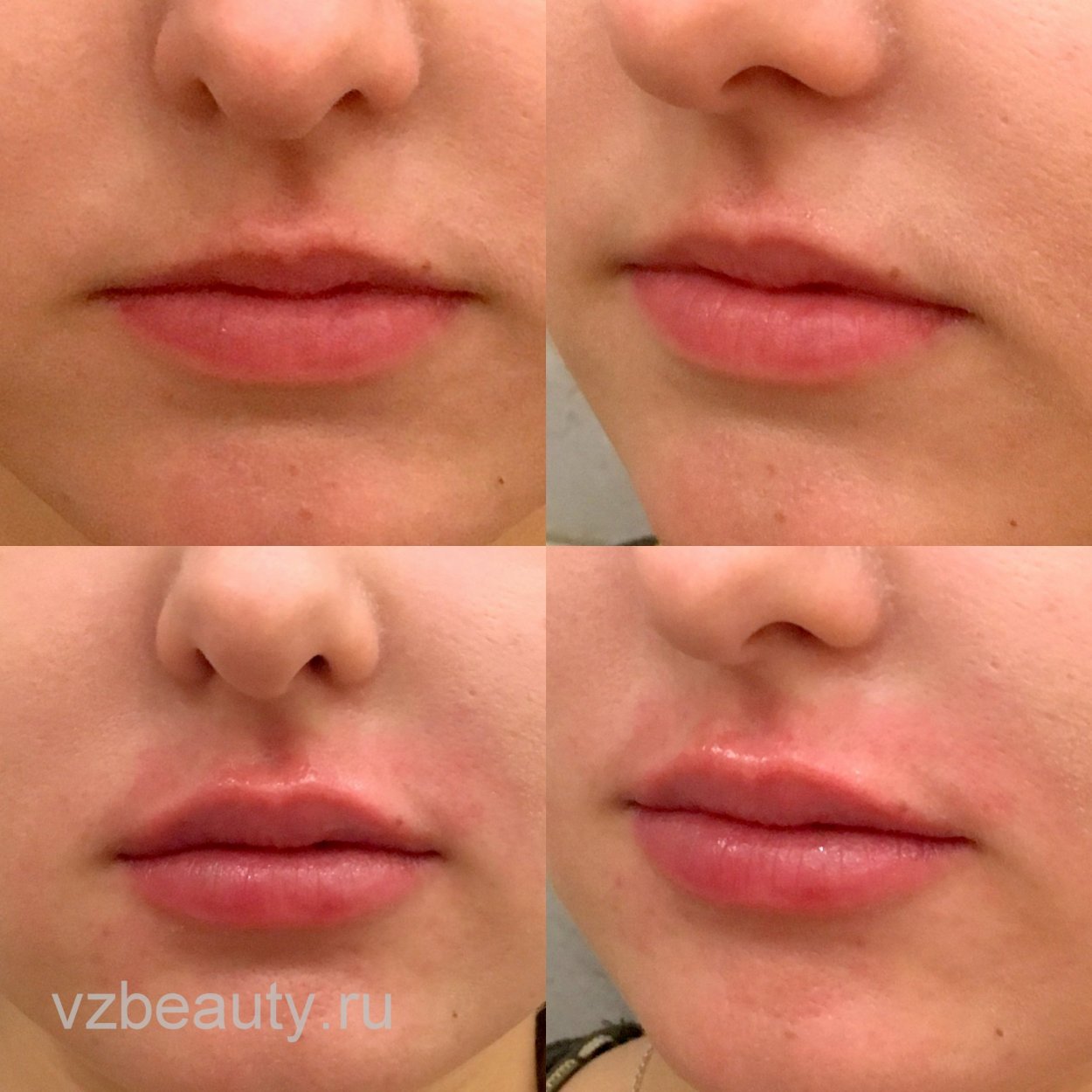 Увеличенные губы красивые
