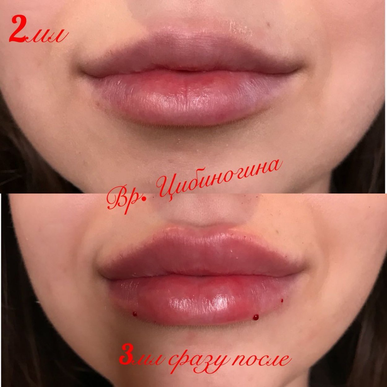 Коррекция верхней губы гиалуроновой кислотой