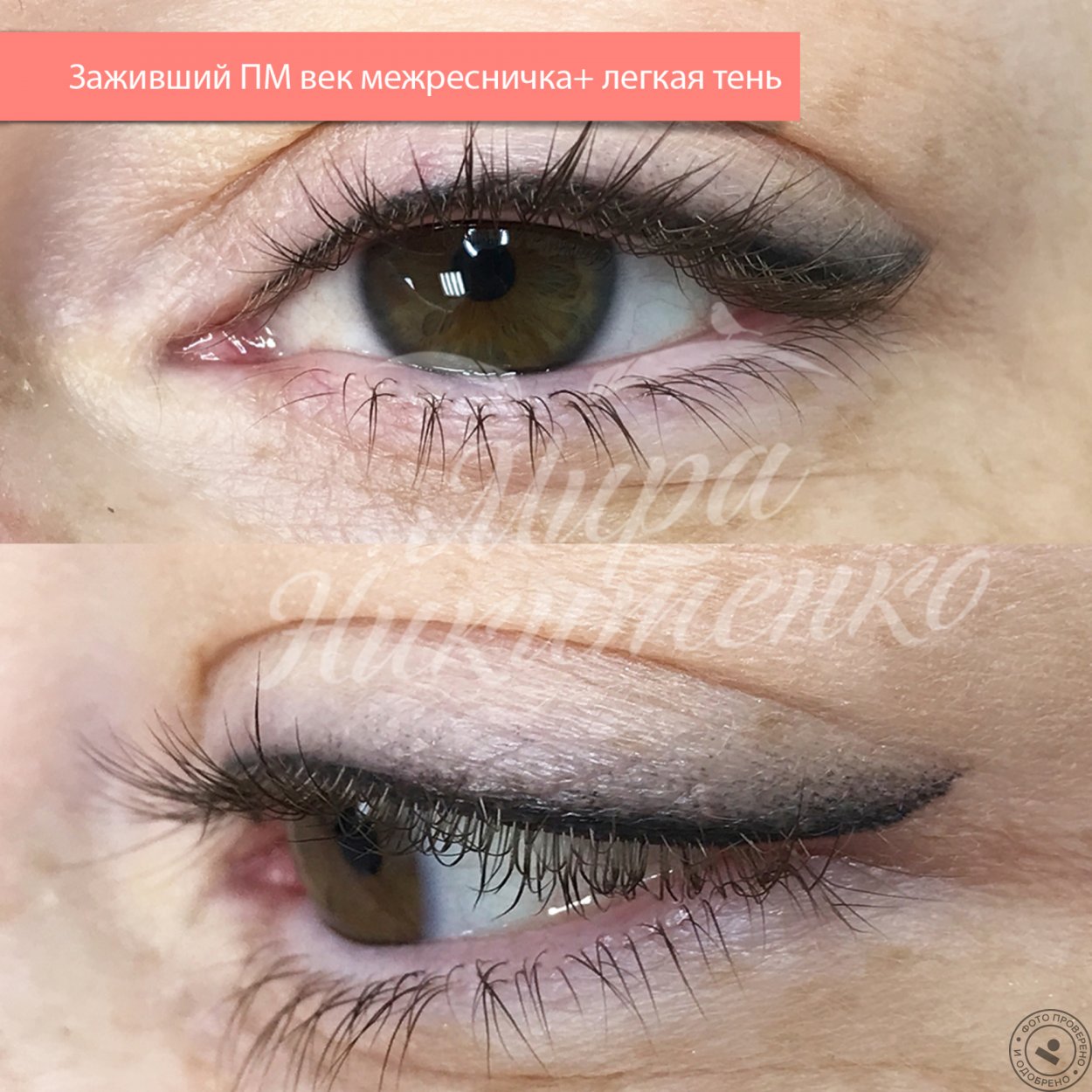Как заживает межресничка