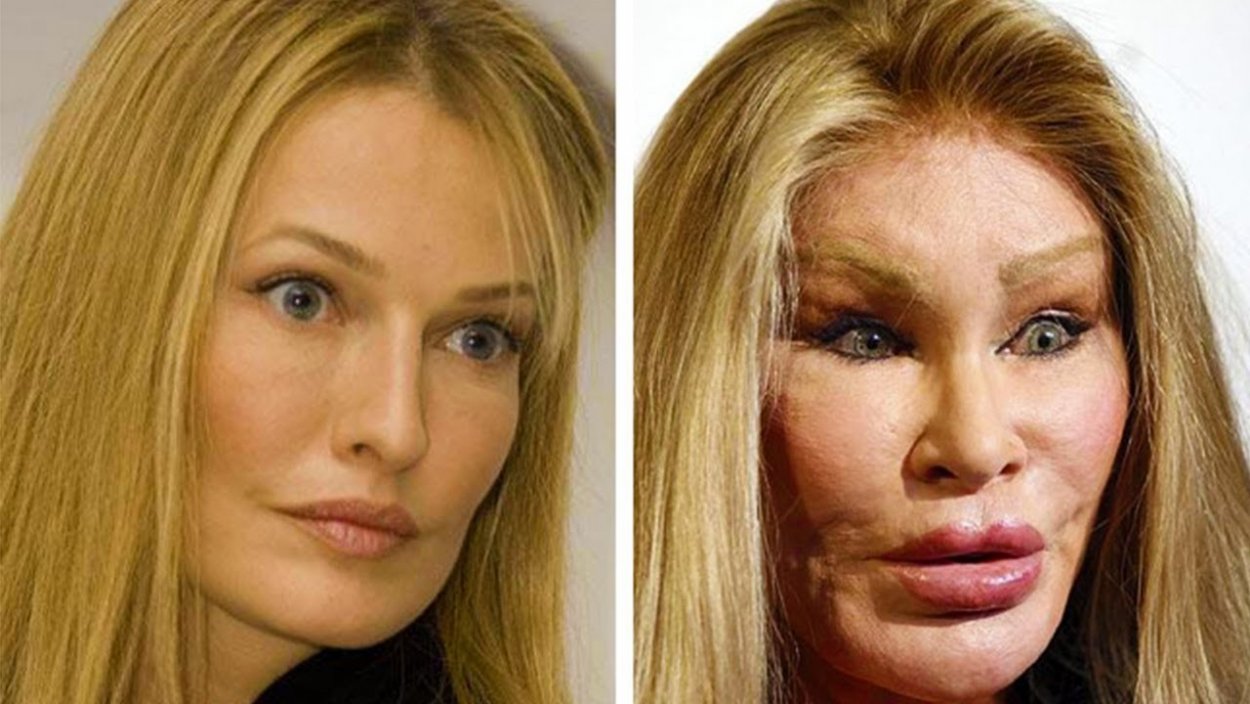 After Botox