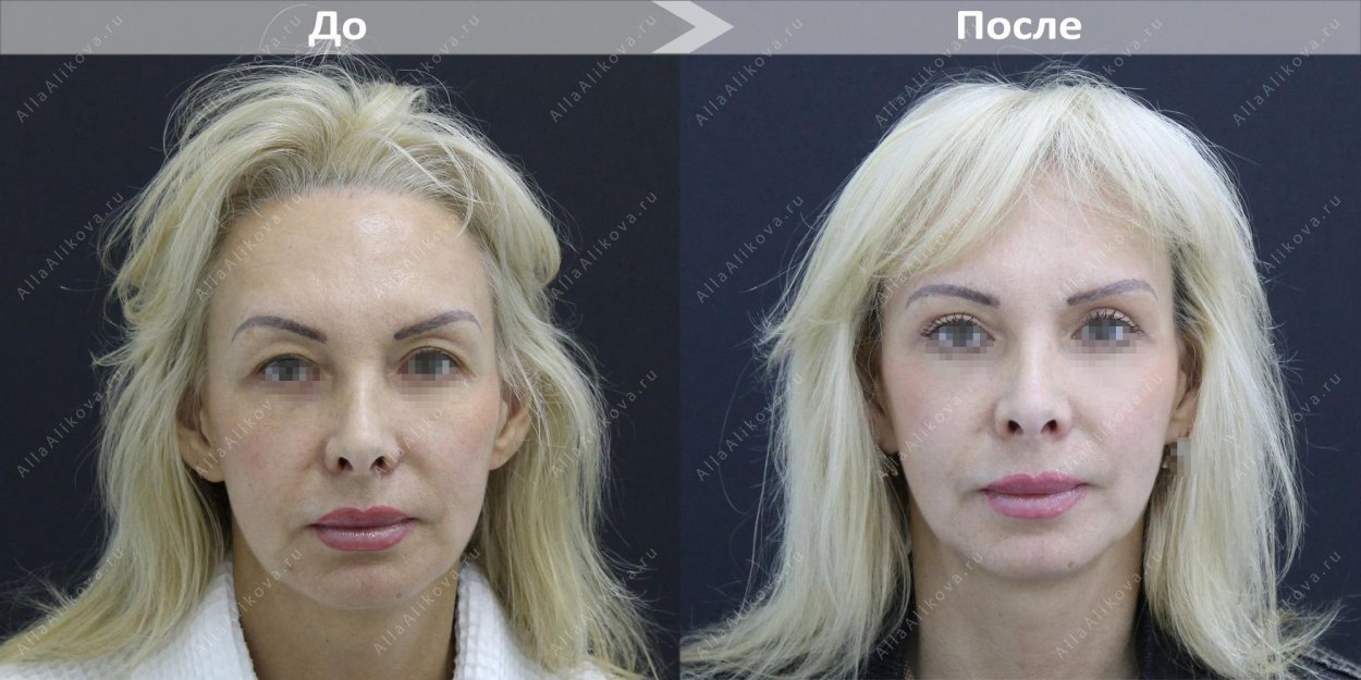 Блефаропластика до и после у молодых