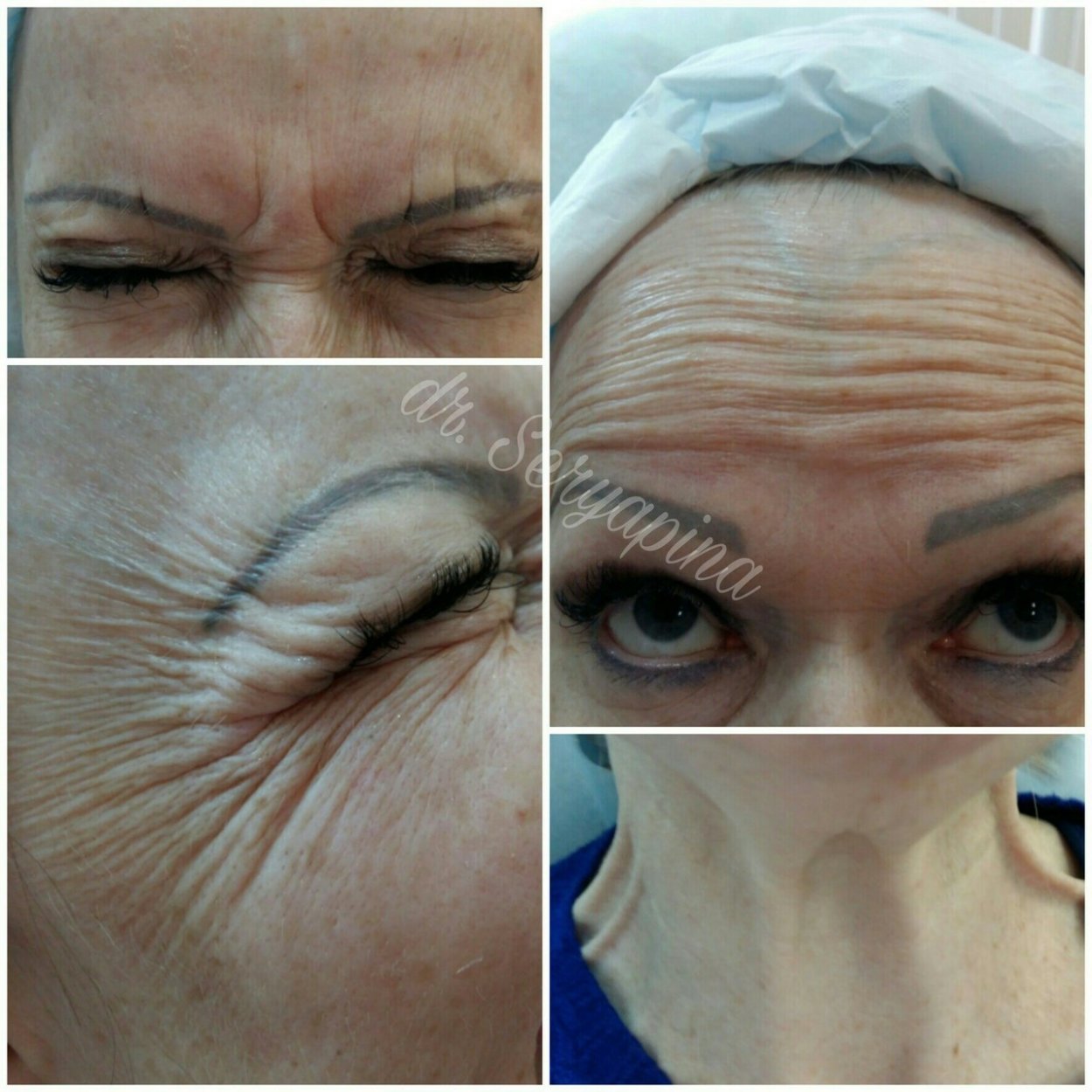 Botox before and after