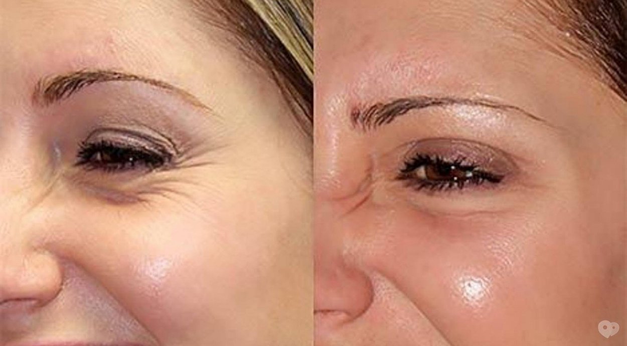 Нити Sculptra