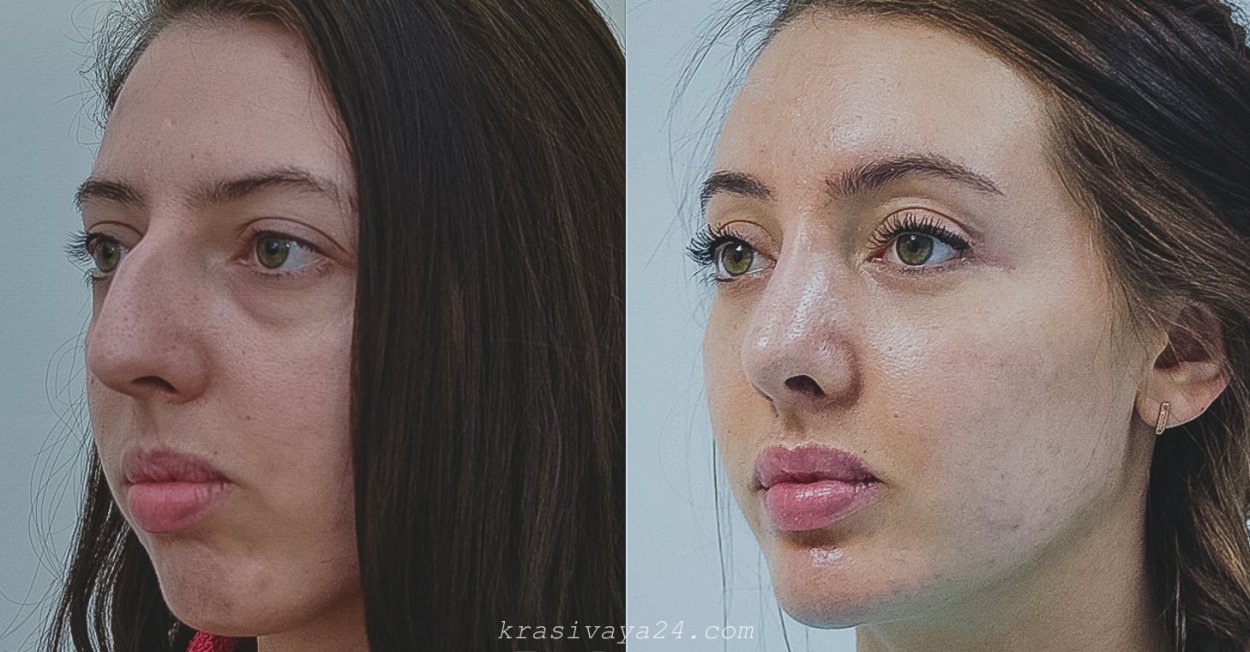 Ринопластика до и после