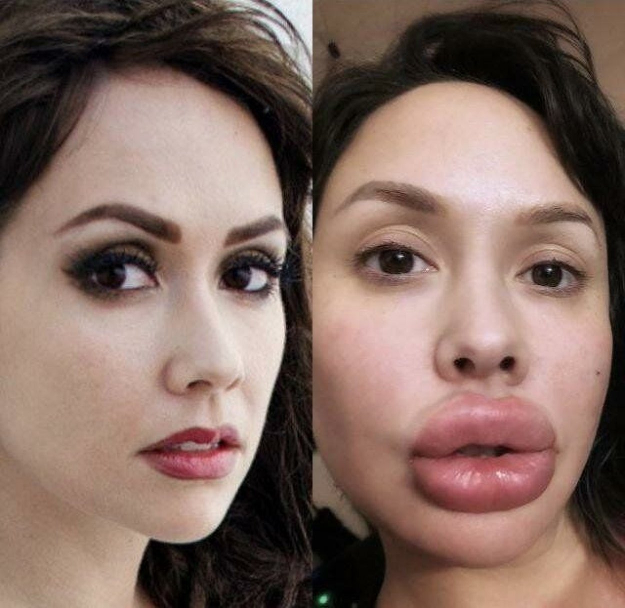 пластика губ до и после фото