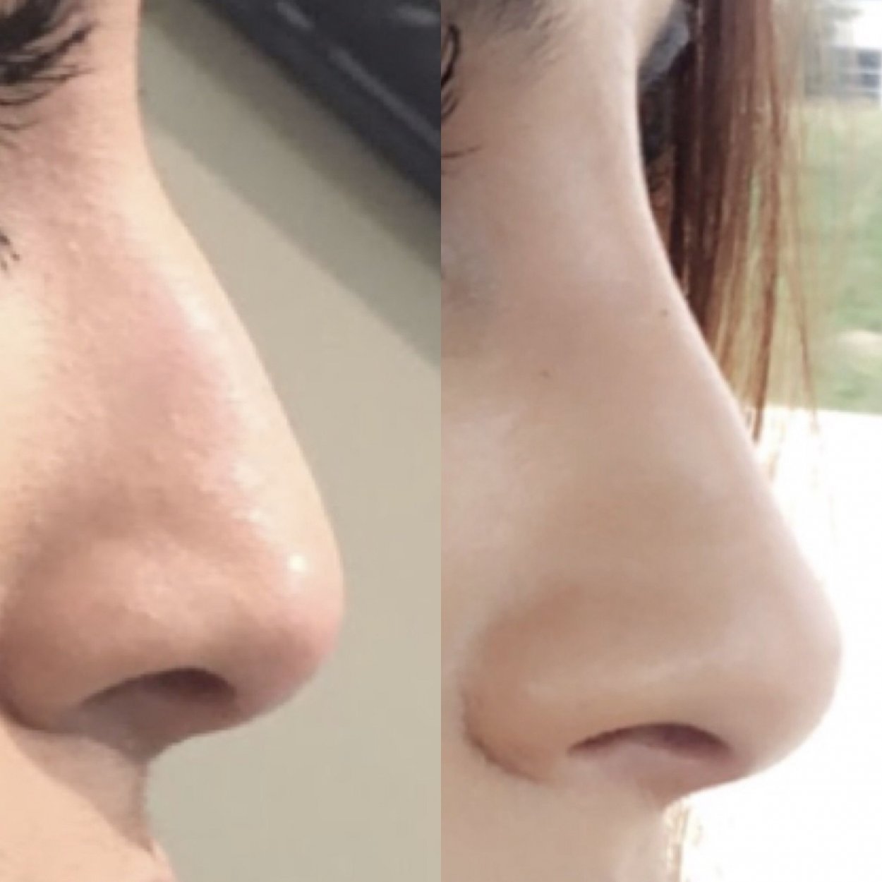 Jawline Dolgusu