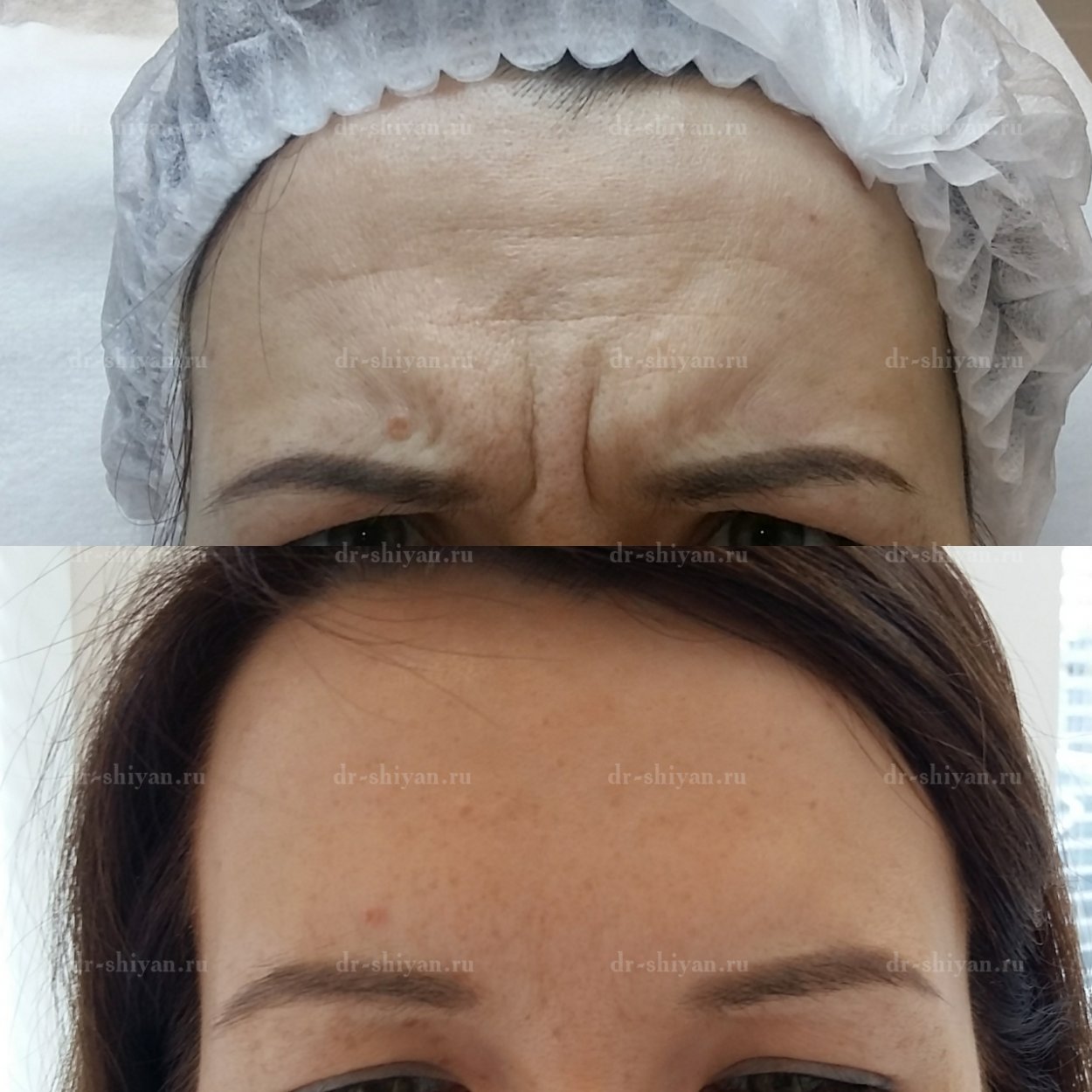 Ботокс межбровье