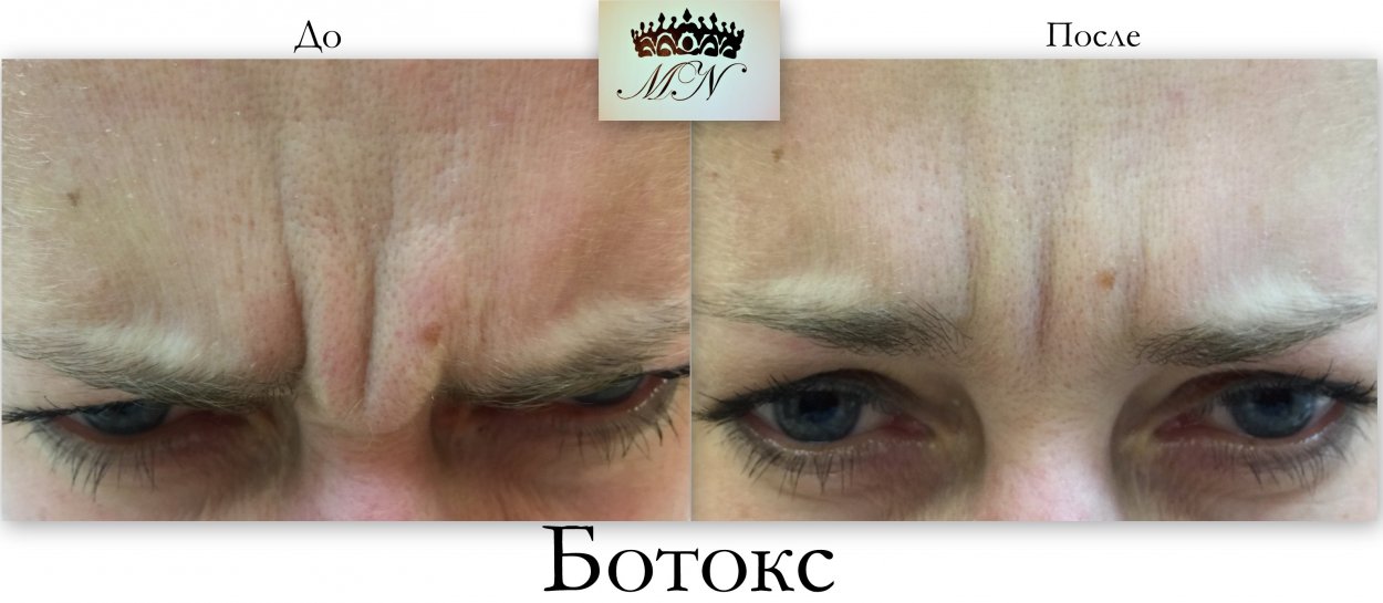 Botox before and after