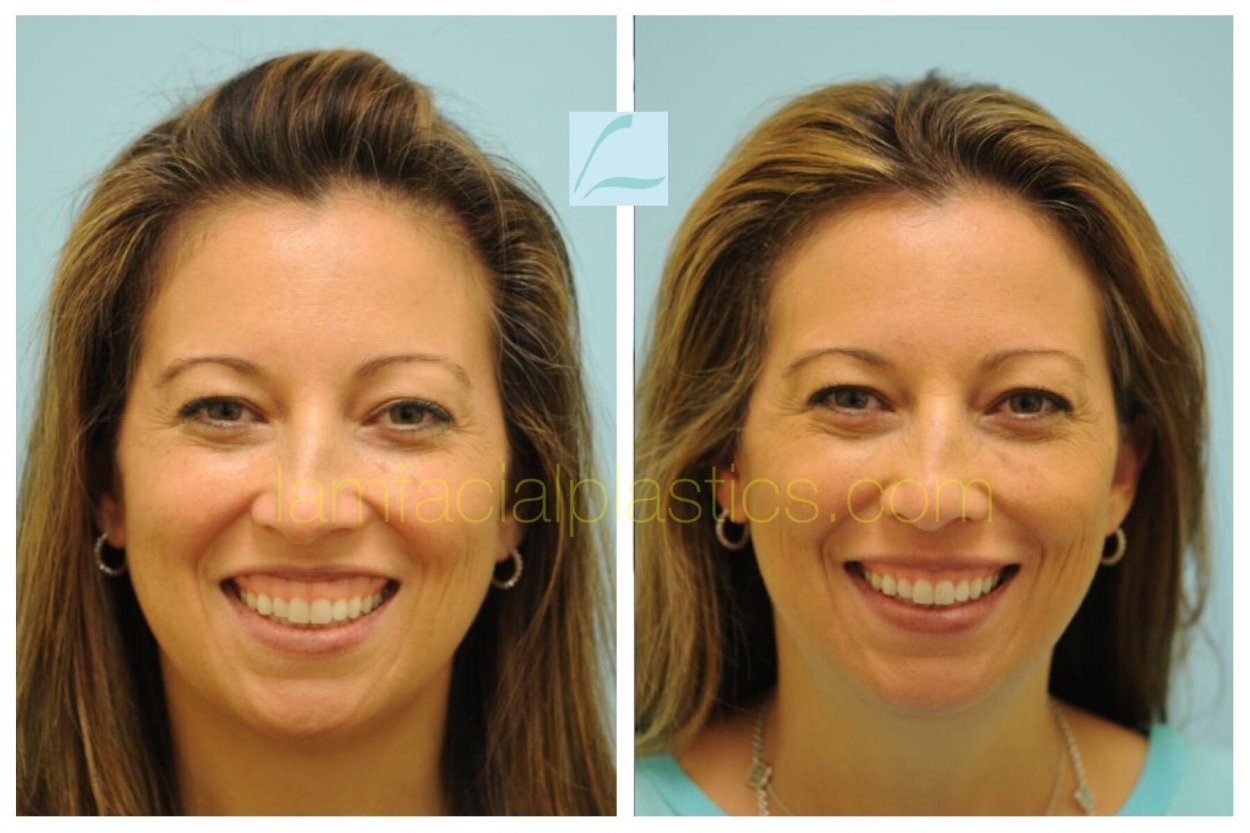 Botox before and after