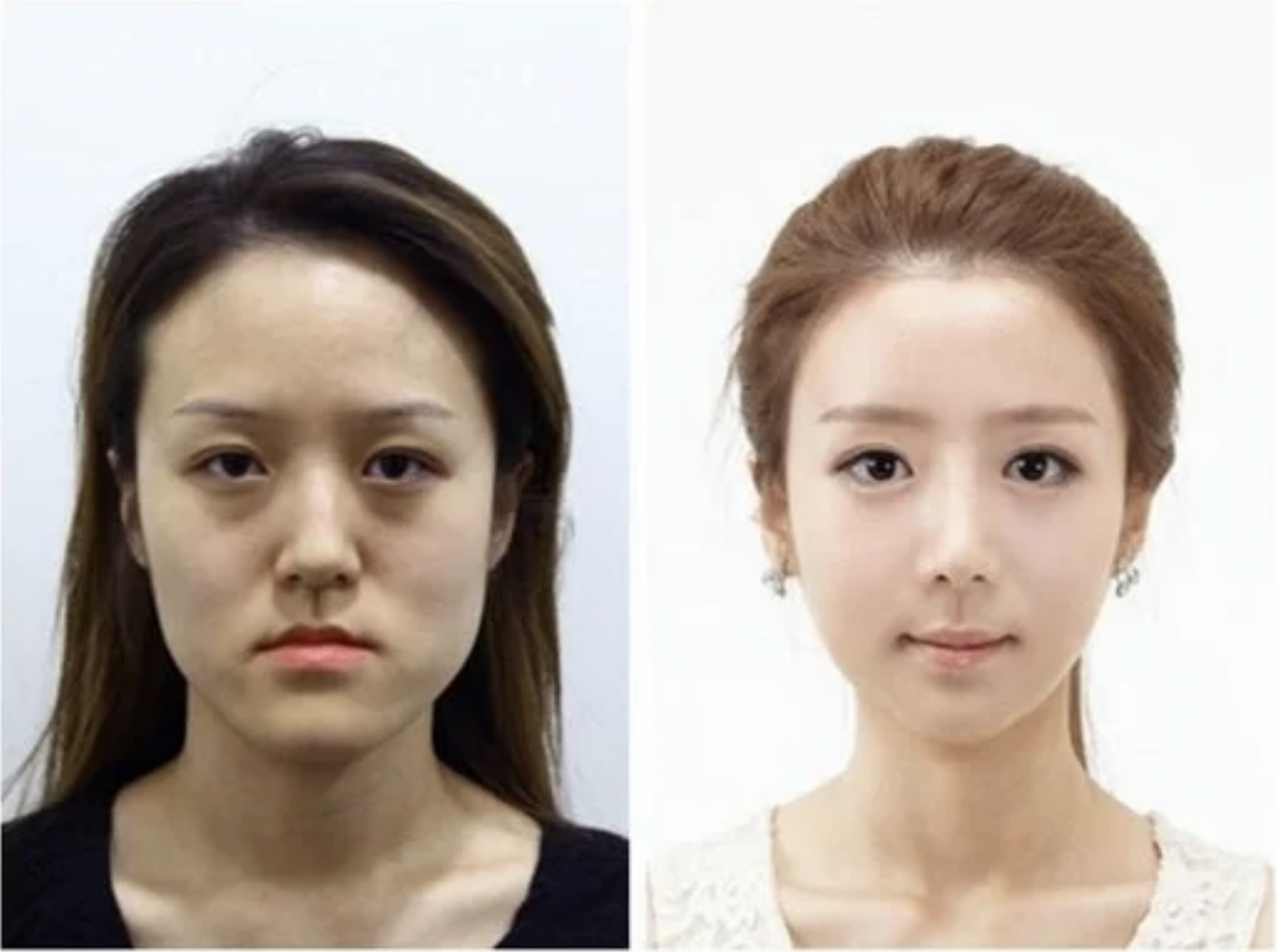 Девушки после пластики лица фото до и после