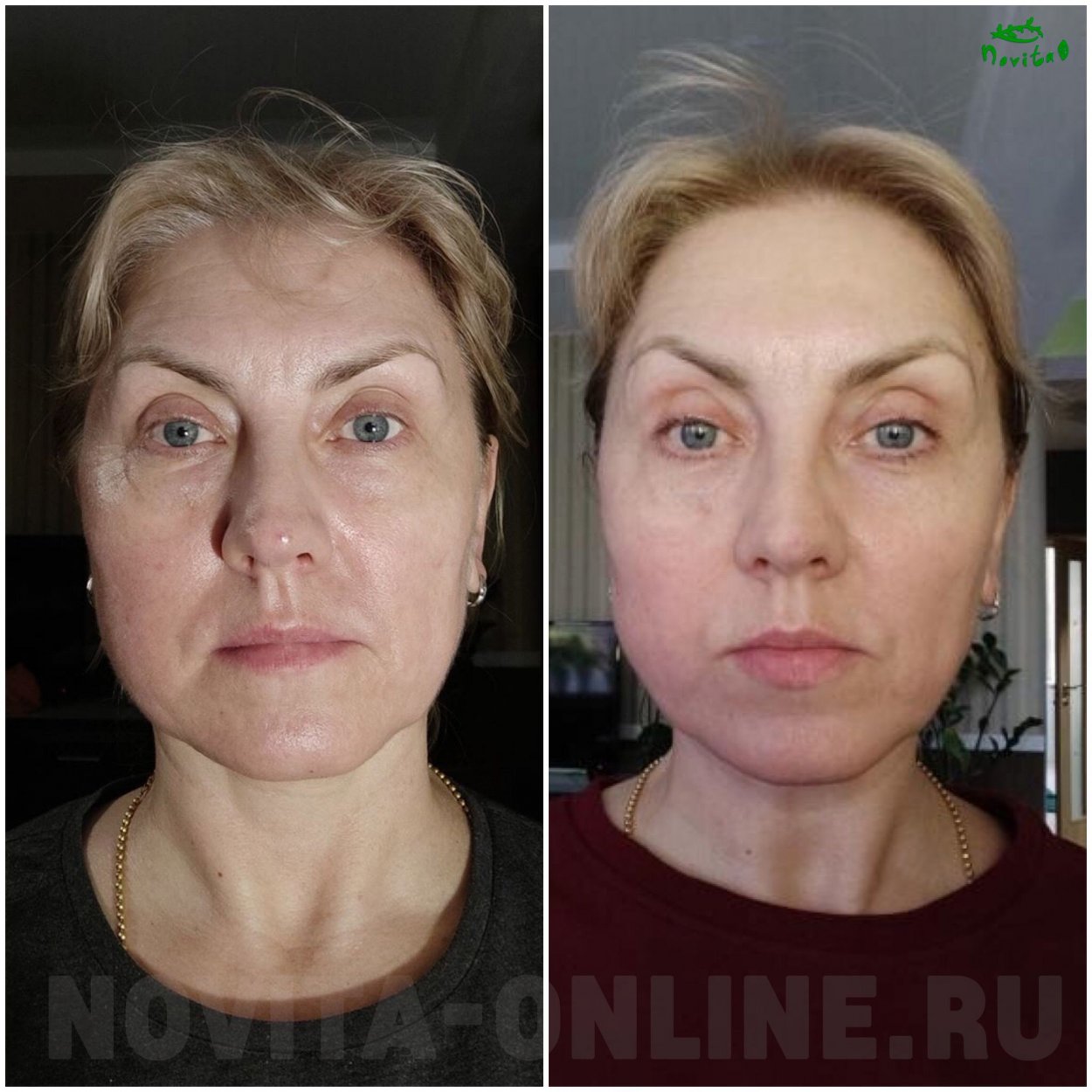 Ботокс вещество