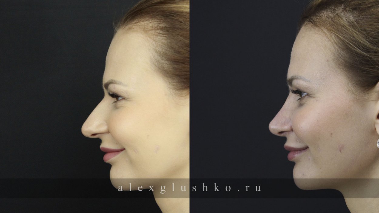 римский нос у женщин фото в профиль