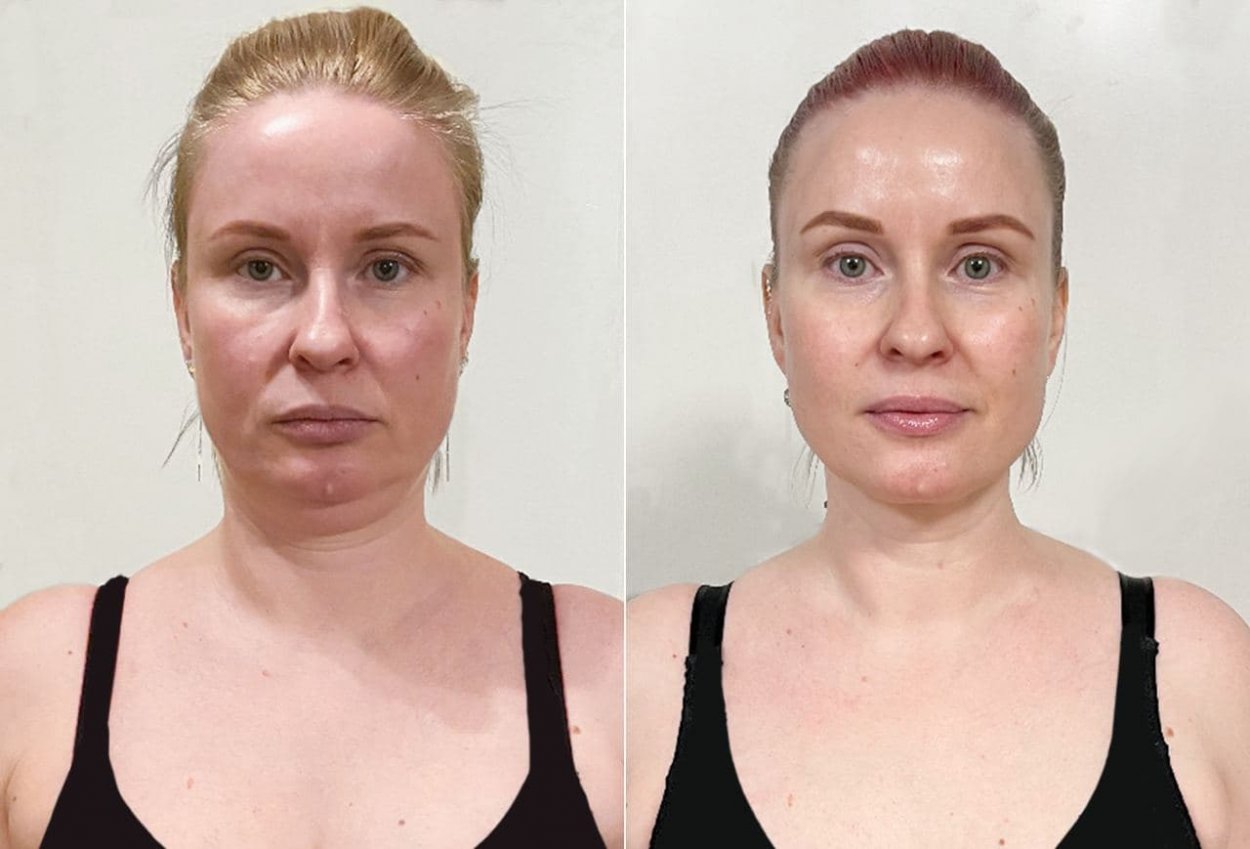 Как расслабить жевательные мышцы лица до и после фото