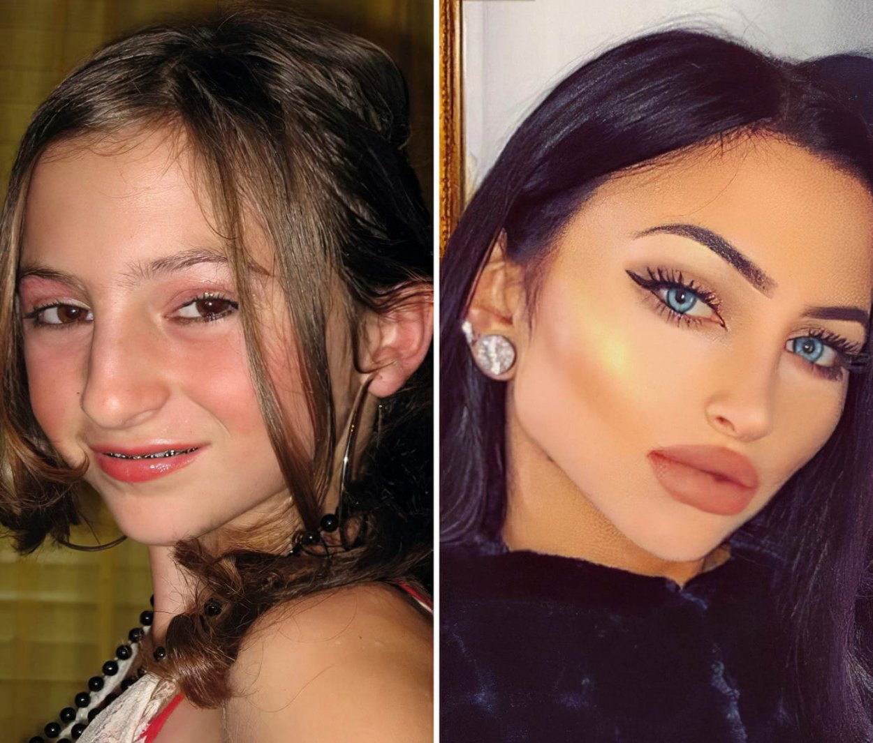 Девушки до и после пластики лица