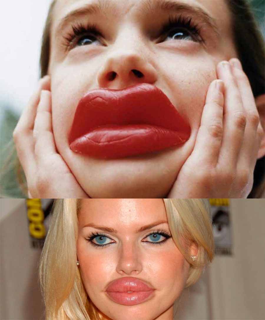 Накачанные быотексом губы