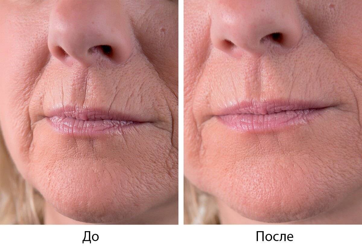 Ботулотоксин в кисетные морщины