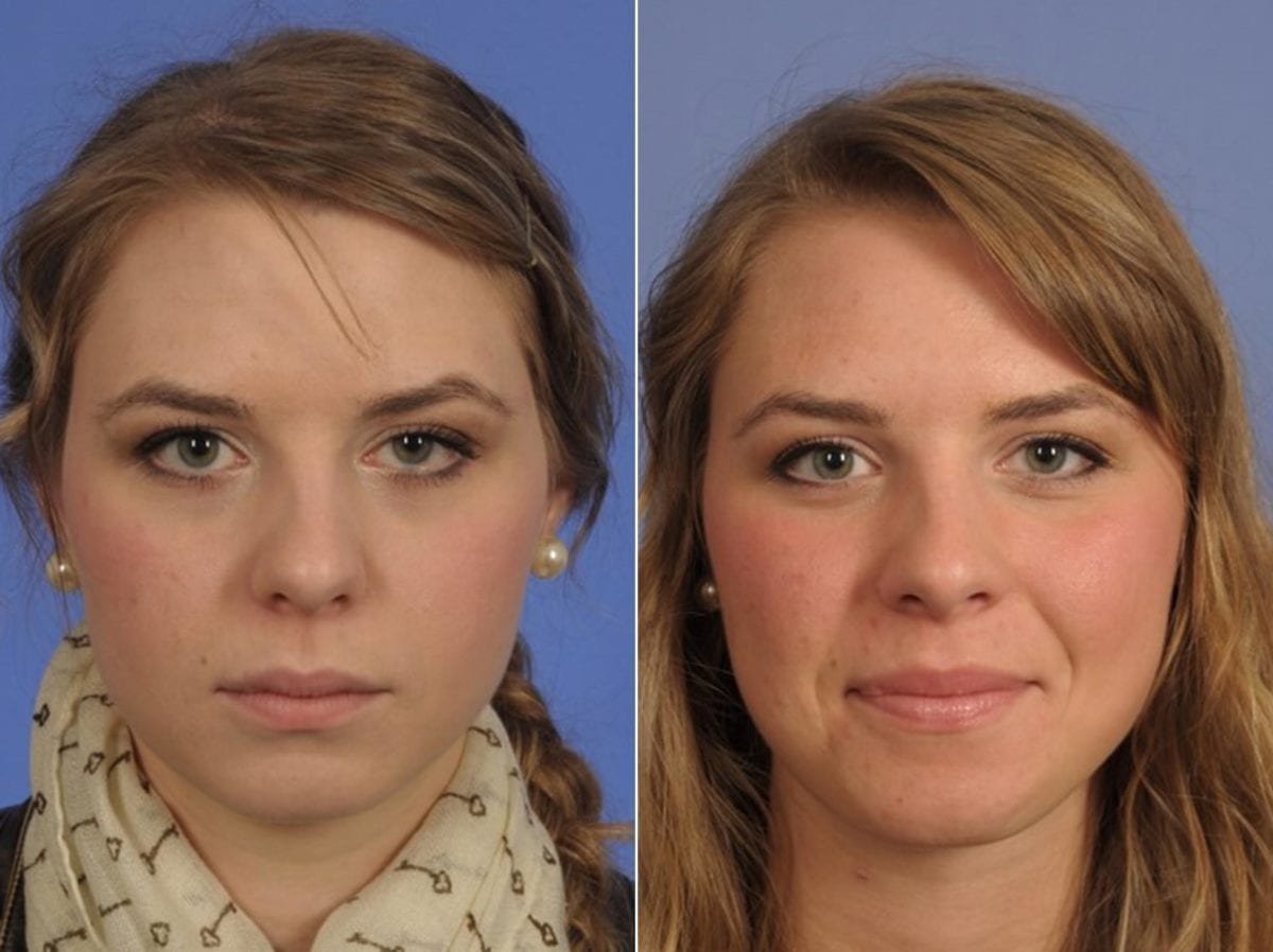 Причины птоза верхнего века у взрослого. Асимметрия лица. Опущенное веко до и после. Коррекция асимметрии лица. Асимметрия глаз операция.