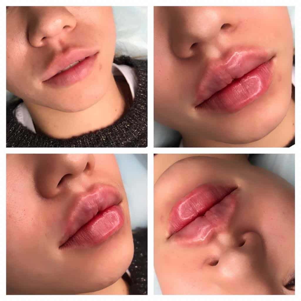 Слегка подкаченные губы до и после фото