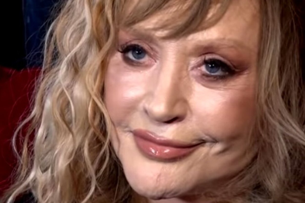 Алла Пугачева пластика 2020
