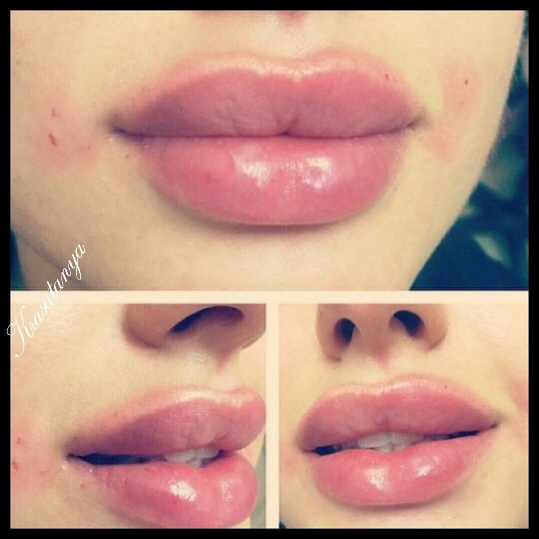 Губы бантиком до и после. Увеличенные губы красивые. Красивое увеличение губ.