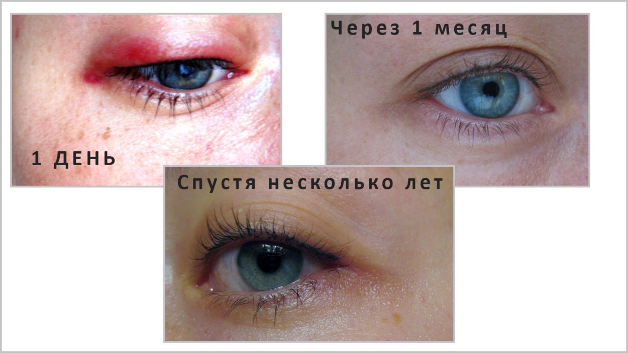 Отек после перманентного макияжа межресничного