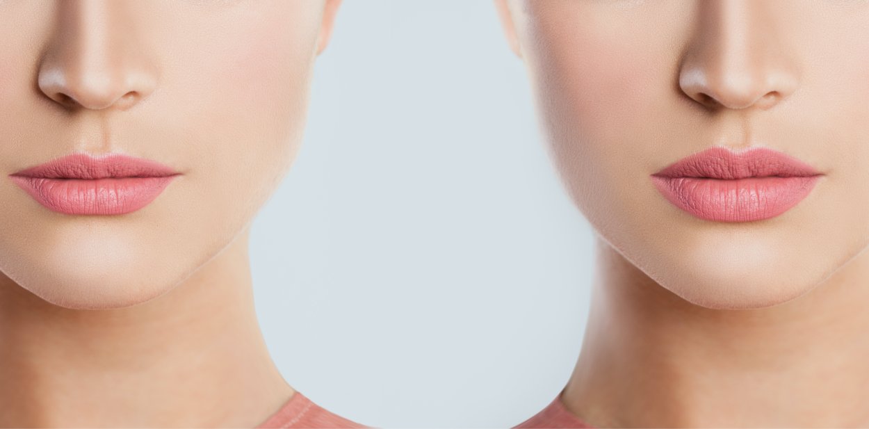 Woman having procedure Lip augmentation