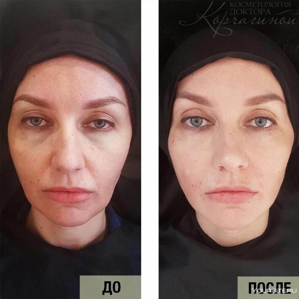 Контурная пластика скул