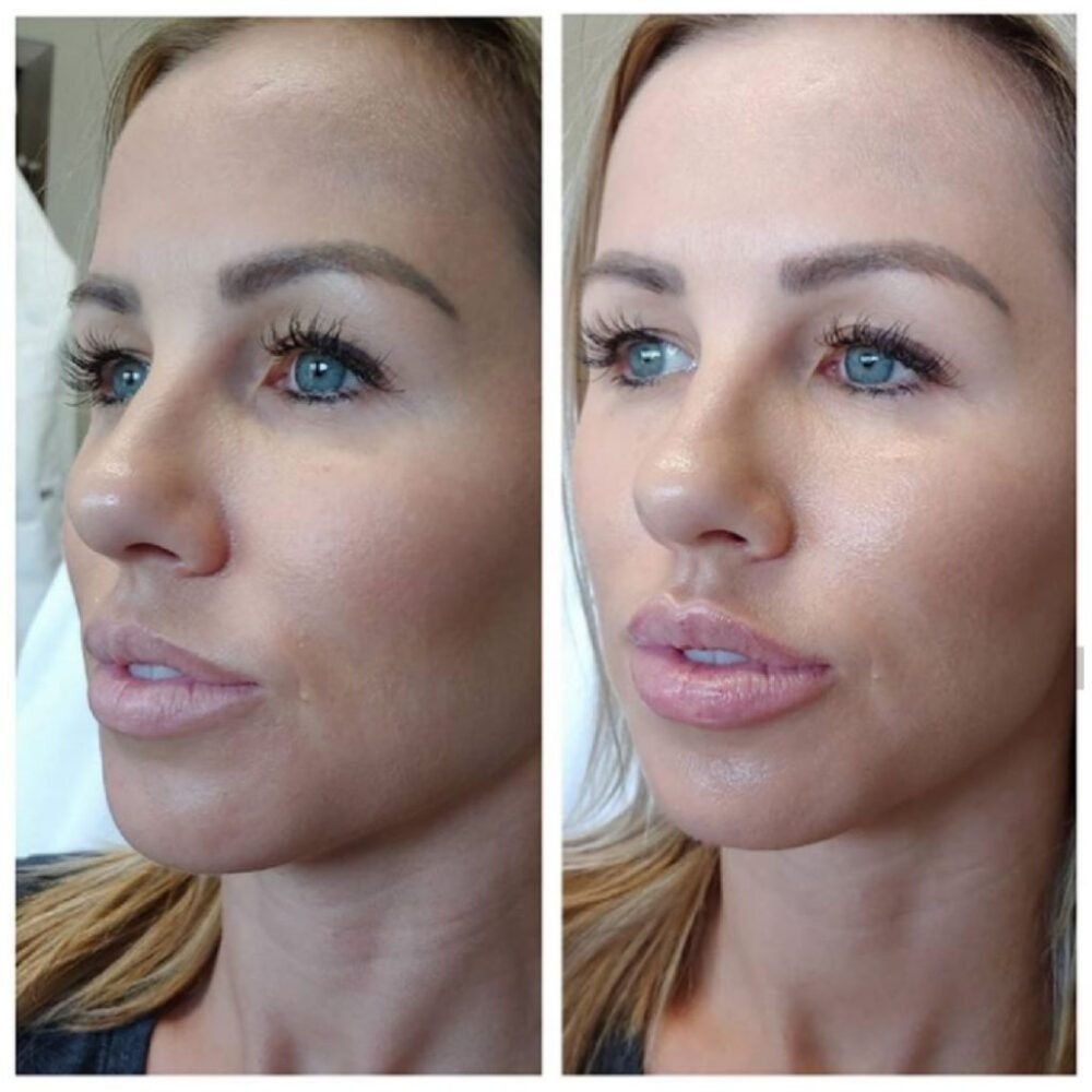 Гиалуроновая кислота Juvederm