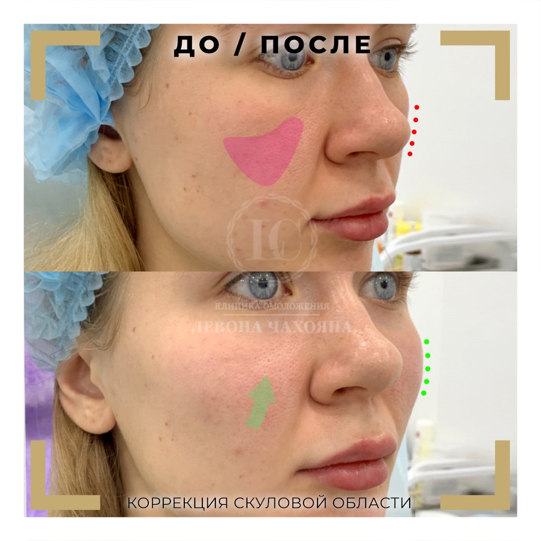 Щечки яблочки филлером до и после