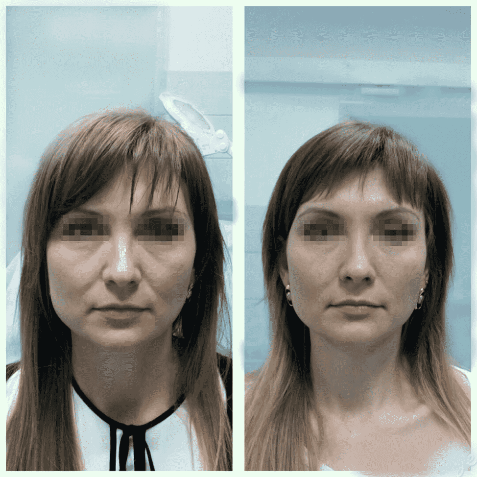 Исправление асимметрии лица