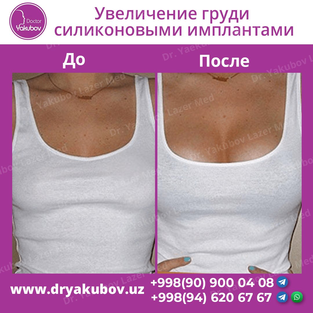 Увеличенная грудь