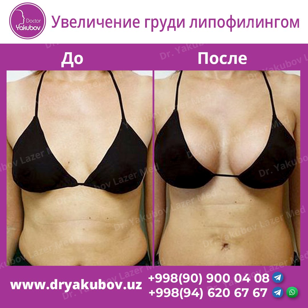 Маммопластика липофилинг