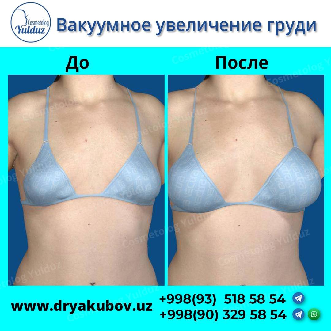 Вакуумное увеличение груди