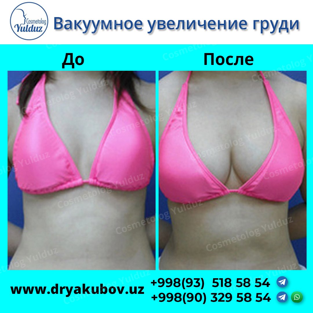 Вакуумное увеличение груди