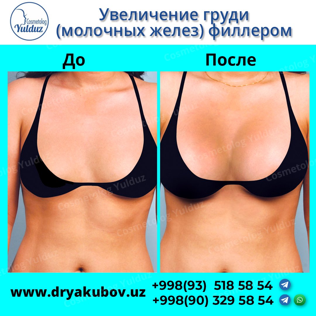 Увеличение для увеличения груди
