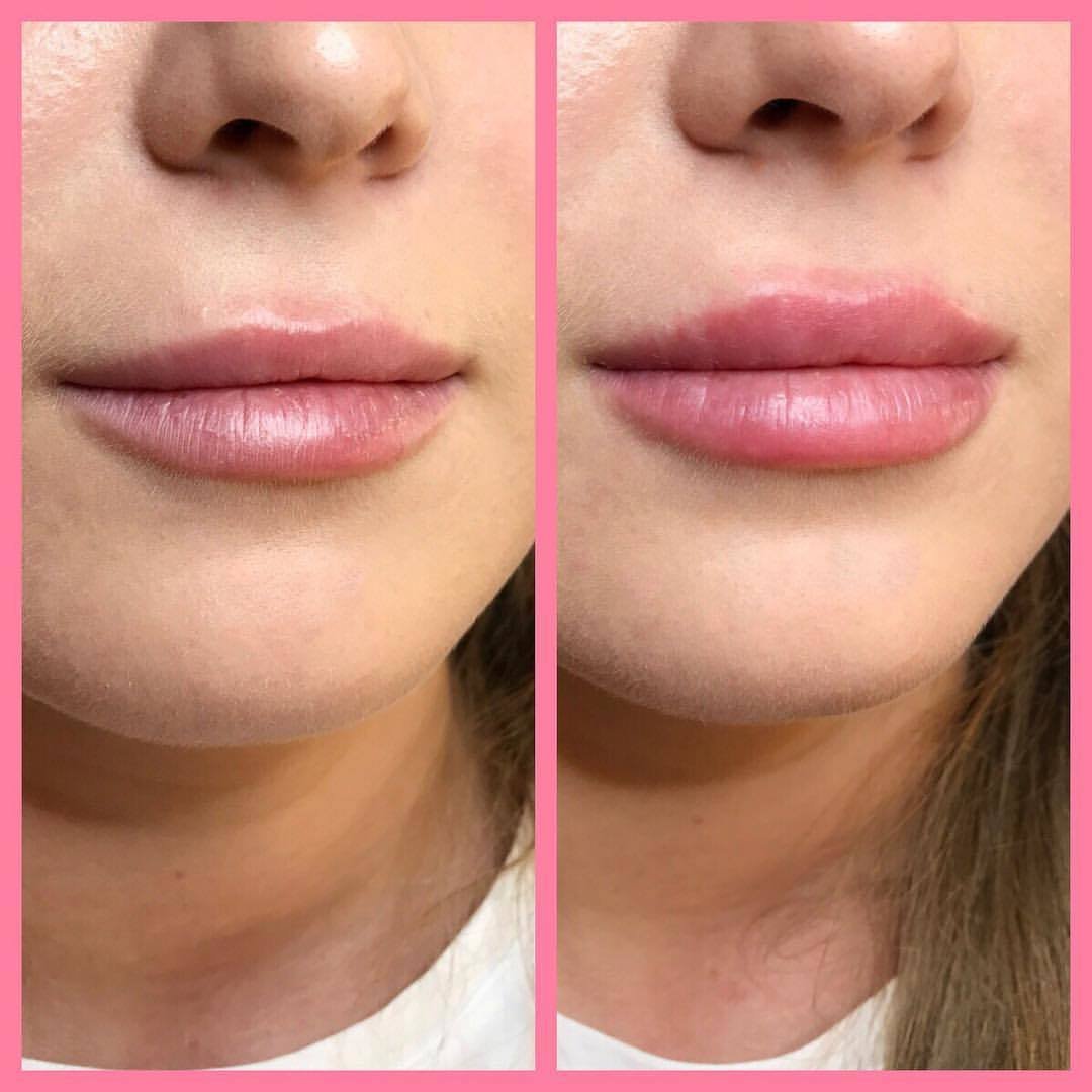 Juvederm Volift Retouch 0.55 мл