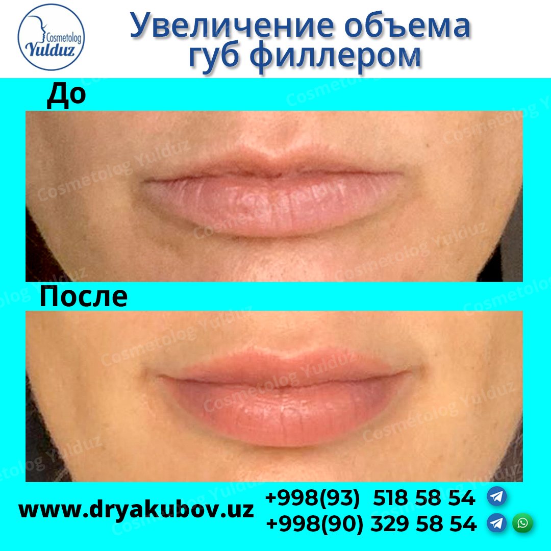 Схема увеличения губ филлером