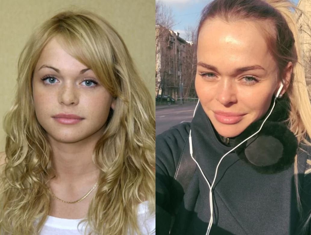 Анна Хилькевич до пластики
