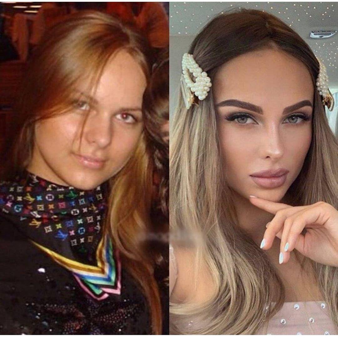 Ханна до пластики