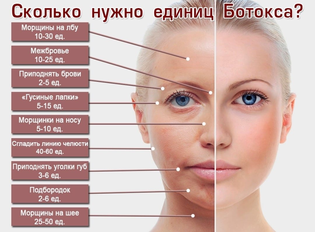 Схема введения ботулотоксина