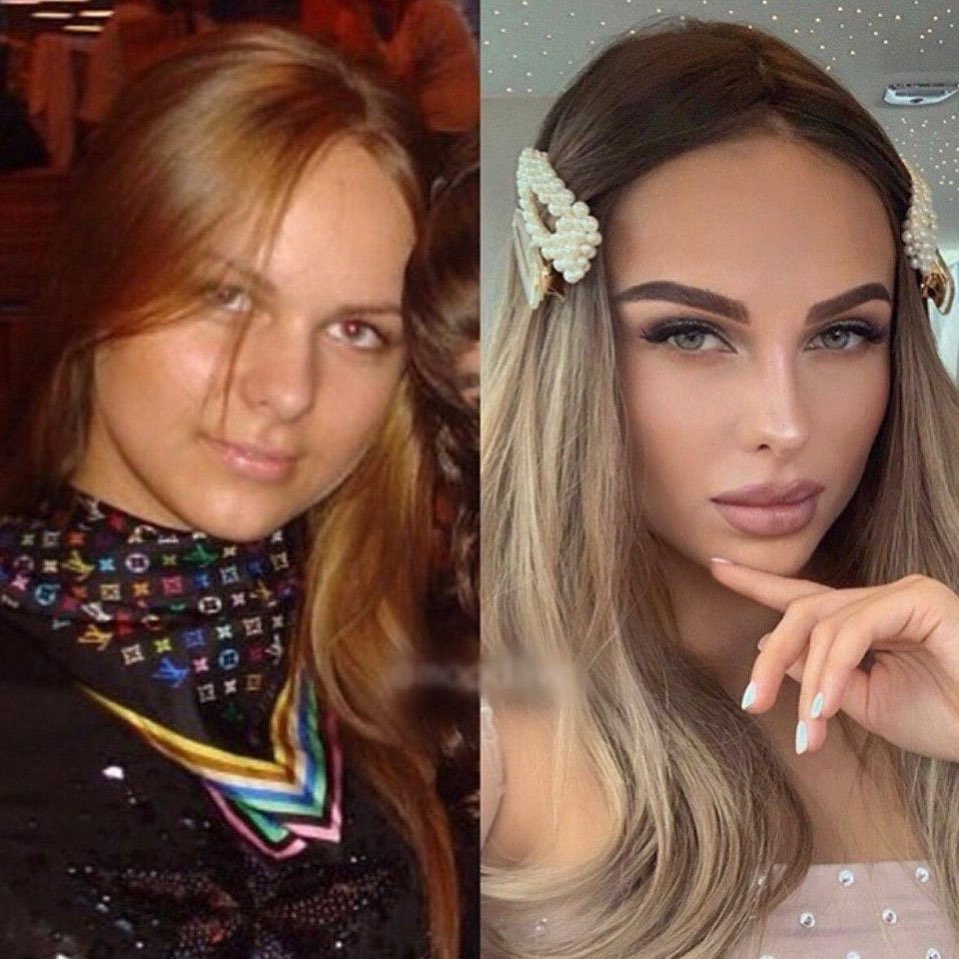 Ханна до пластики