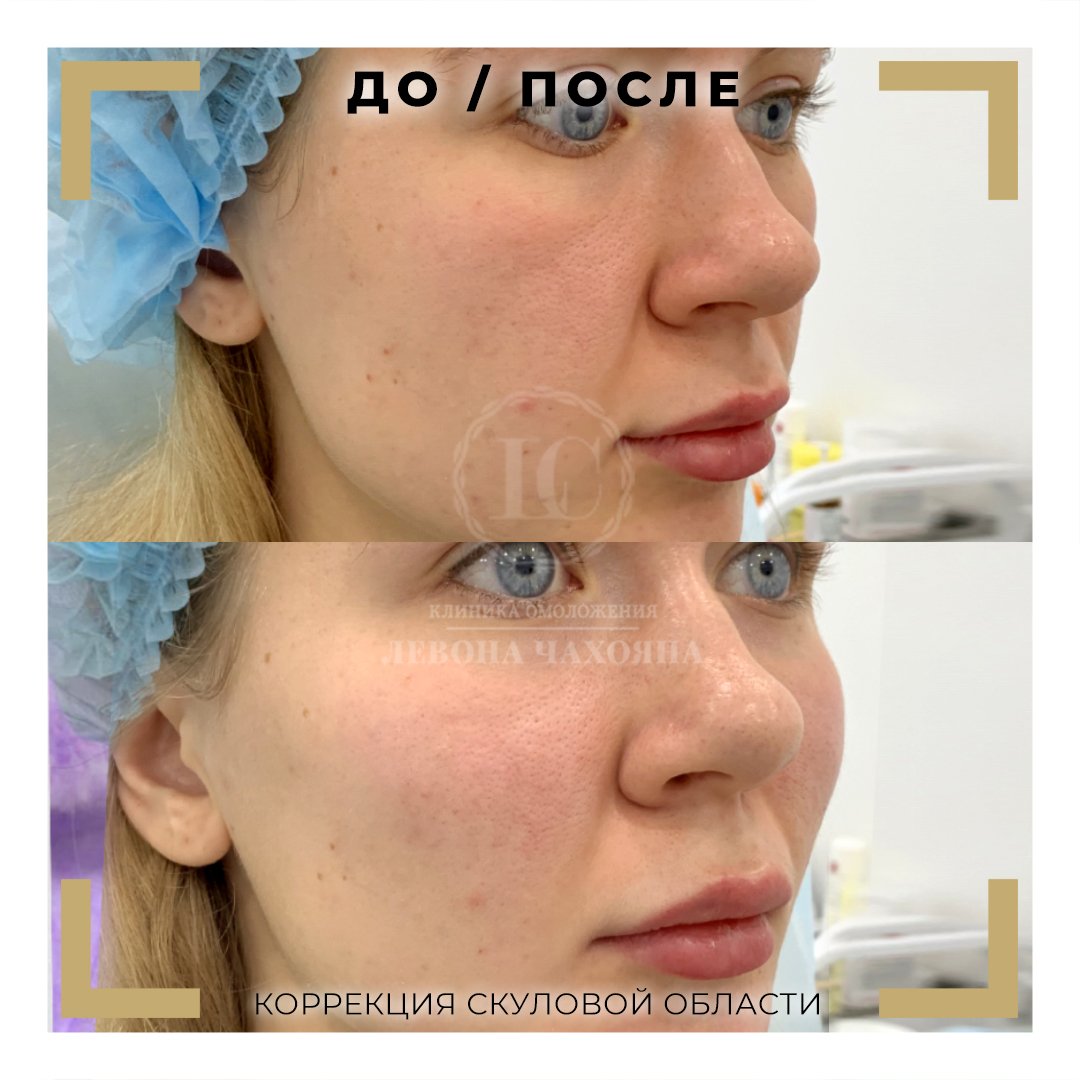 Щечки яблочки филлером