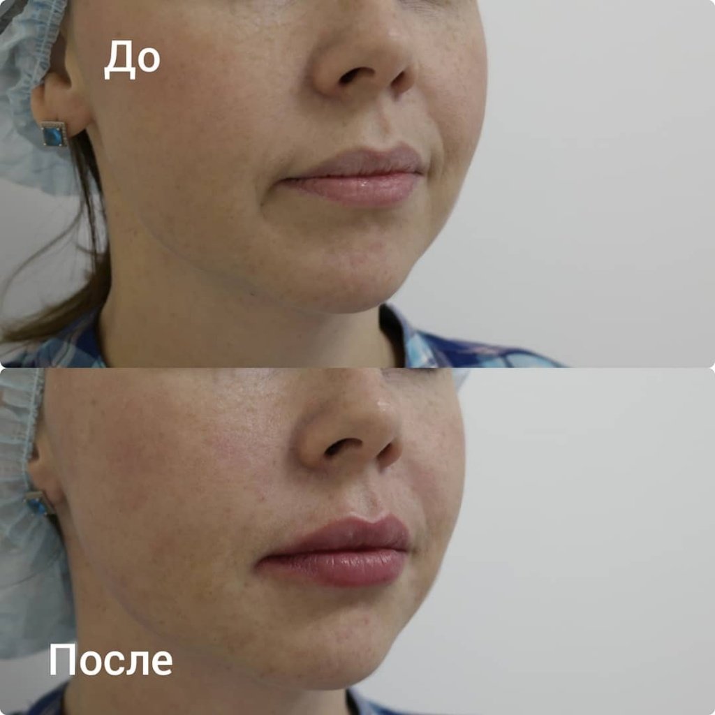 Пластика скул гиалурованной кислотой